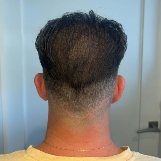 Groeit er haar over een tattoo? Dit moet je weten