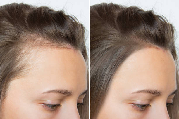Micro haar pigmentatie voor vrouwen: dit moet je weten